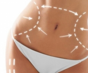 Lipoescultura Lipoescultura