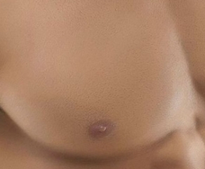 Prótese de Peitoral Prótese de Peitoral