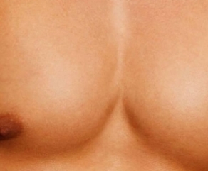 Ginecomastia Ginecomastia