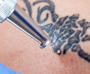 Remoção de Tatuagens Remoção de Tatuagens