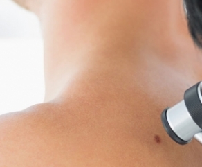 Tumores Cutâneos Tumores Cutâneos